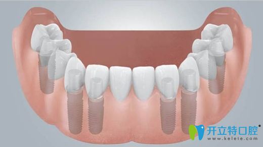 顧騰飛醫(yī)生科普無(wú)牙頜全口義齒修復(fù)技術(shù) 顧騰飛醫(yī)生科普無(wú)牙頜全口義齒修復(fù)技術(shù)