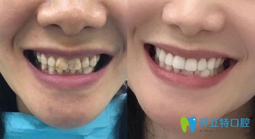 在寧波江北區(qū)恒美口腔做瓷貼面的前后效果圖