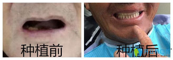 通過(guò)ALL-ON-4半口全口種植牙效果來(lái)了解靖江艾齒嘉口腔怎么樣