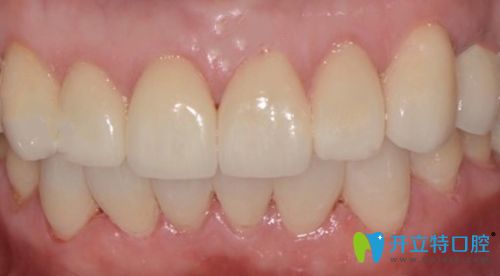 在寧波恒美口腔我選了自然色的牙貼面