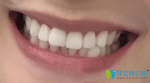 我做完瓷貼面沒有很假而是很自然