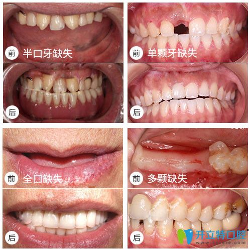 全口，半口種植牙真實(shí)案例及前后對比效果