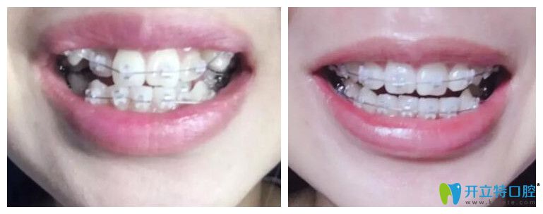 天津美奧口腔陶瓷托槽牙齒矯正