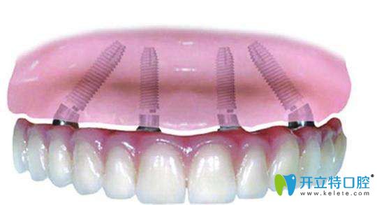 天津愛齒口腔周航醫(yī)生介紹無牙頜即刻種植修復優(yōu)勢