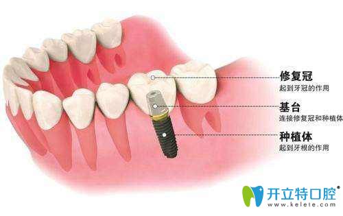 德國(guó)和瑞士種植體哪個(gè)好,解析德國(guó)種植體比瑞士便宜的原因