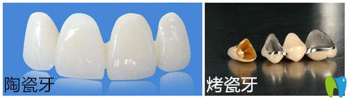 陶瓷牙和烤瓷牙的區(qū)別有哪些?分享兩者價(jià)格及優(yōu)缺點(diǎn)給大家