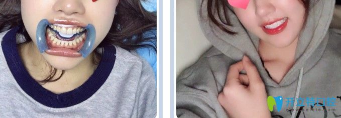 來看看小姐姐們在蘇州康美口腔做超薄瓷貼面是否磨牙了