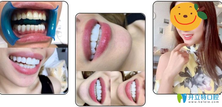 在蘇州康美口腔做了超薄牙貼面前后對比圖 在蘇州康美口腔做了超薄牙貼面前后對比圖