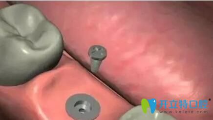 種植牙上基臺(tái)示意圖