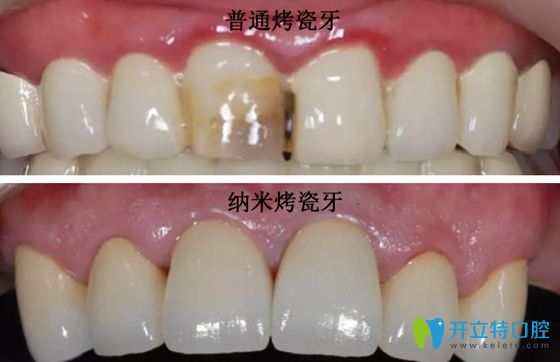 普通烤瓷牙與納米烤瓷牙效果對(duì)比圖