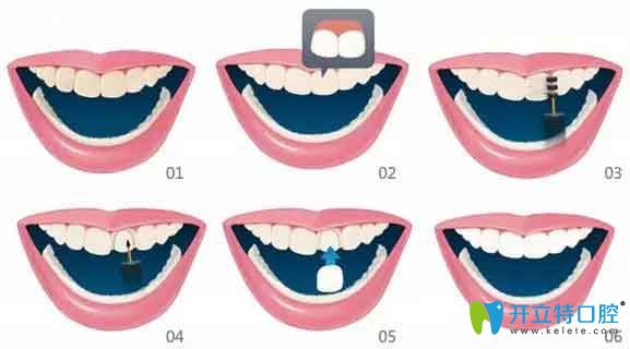 牙齒貼面中的愛威白和美加哪個(gè)好,從價(jià)格和優(yōu)缺點(diǎn)區(qū)別吧！
