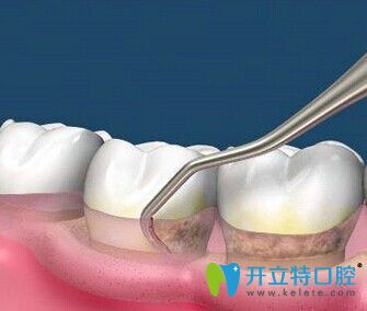 牙齒松動齦下刮治治療