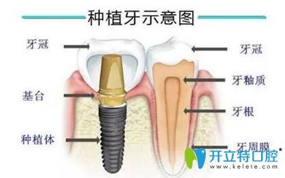 必看！種植牙愈合帽和愈合基臺(tái)及愈合基臺(tái)和修復(fù)基臺(tái)區(qū)別