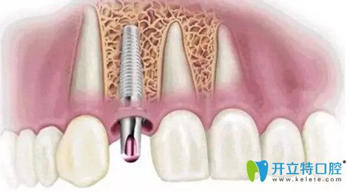 種植牙怎么選？從壽命及價(jià)格評(píng)測(cè)德國(guó)camlog種植體怎么樣