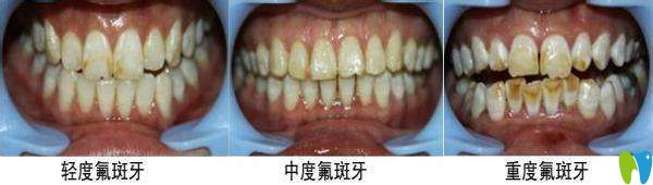 氟斑牙的美白方法大全并附價(jià)格表，看看哪種省錢又適合你