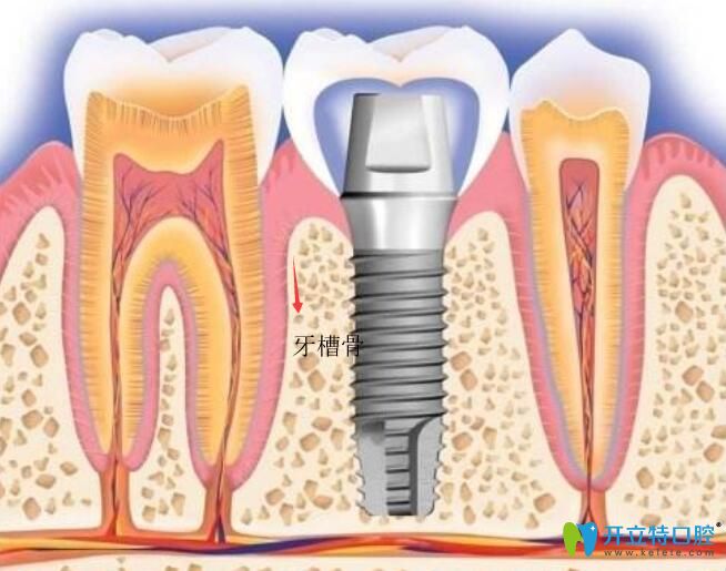 種植體距離上頜竇距離多少安全？穿透上頜竇有什么問題？