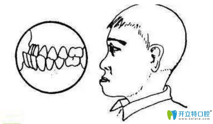 地包天建議在康美做正畸