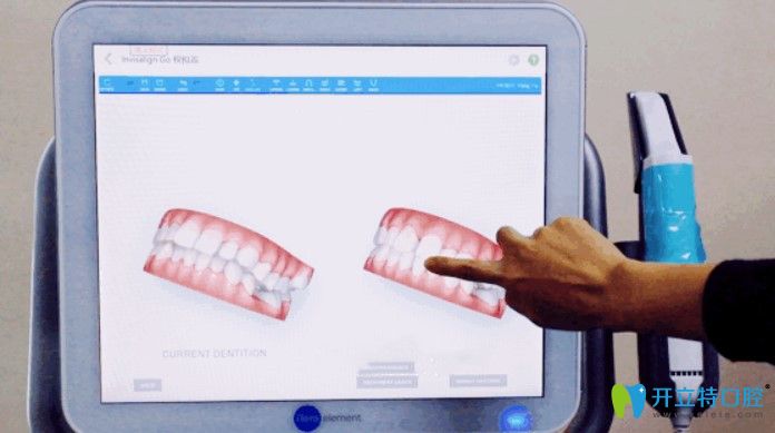 維樂(lè)口腔iTero口掃可以讓你提前預(yù)知矯正效果