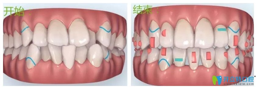 隱適美隱形矯正優(yōu)勢(shì)