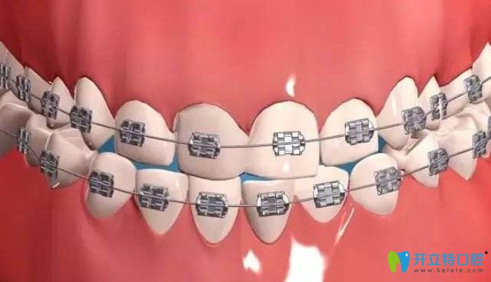 金屬托槽矯正優(yōu)缺點(diǎn)解析