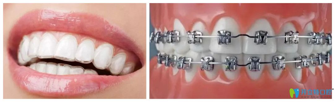 南通康美口腔為您揭秘：隱適美矯正與傳統(tǒng)矯正哪個(gè)效果好