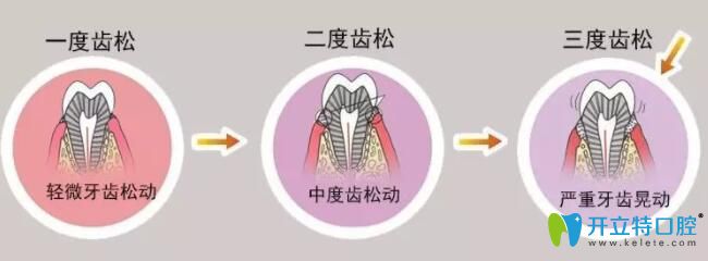 牙齒松動的程度