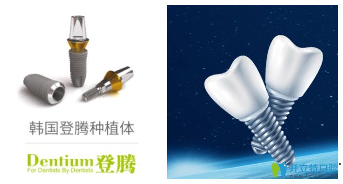 福州維樂(lè)口腔登騰種植牙價(jià)格