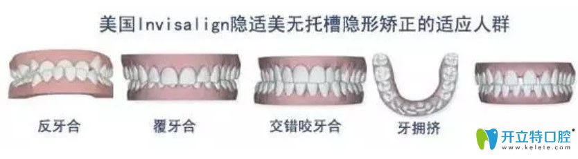 隱適美隱形矯正適用的牙齒情況