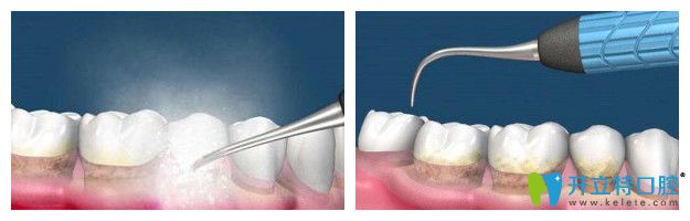 北極星口腔洗牙圖 北極星口腔洗牙圖