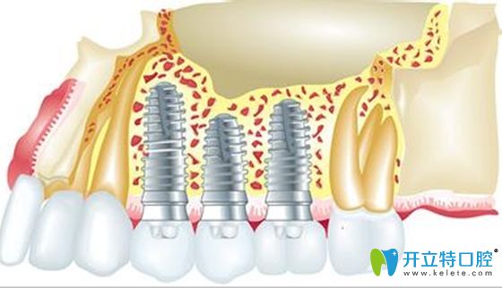 骨量不足種牙不植骨的后果會怎樣