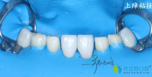 牙齒貼面上障粘結 牙齒貼面上障粘結