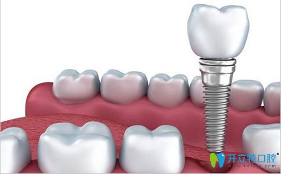 意大利西泰克和瑞士iti種植牙區(qū)別