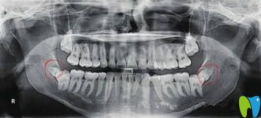 阻生牙一定要拔除嗎