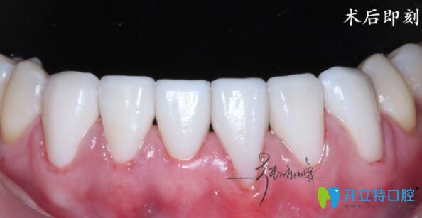 牙齒貼面真人案例 牙齒貼面真人案例