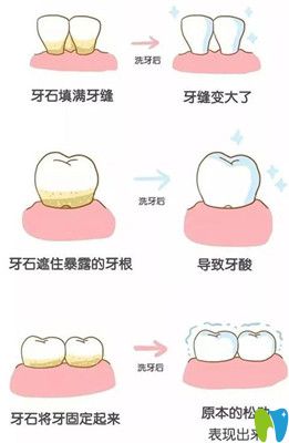 洗牙有什么好處 洗牙有什么好處