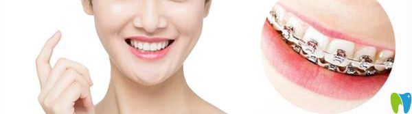 美奧金屬托槽矯正