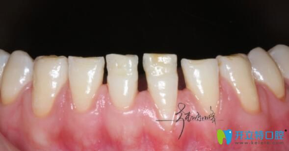 深圳牙齒貼面哪家醫(yī)院好 深圳牙齒貼面哪家醫(yī)院好