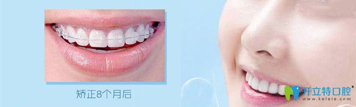 托槽半隱形矯正