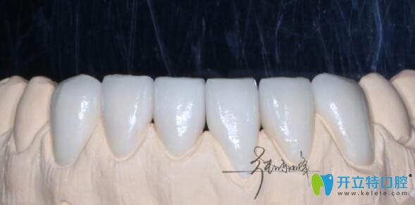 牙齒貼面?zhèn)溲缊D 牙齒貼面?zhèn)溲缊D