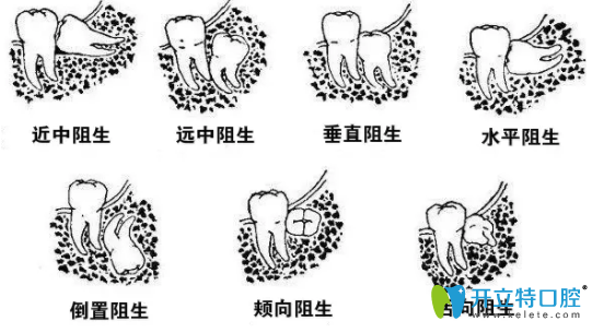 阻生牙生長(zhǎng)的形態(tài)