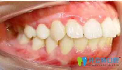 骨性深覆合圖片