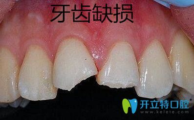 牙齒缺損修復(fù)選擇金屬牙冠、烤瓷牙冠和全瓷牙冠哪個好？