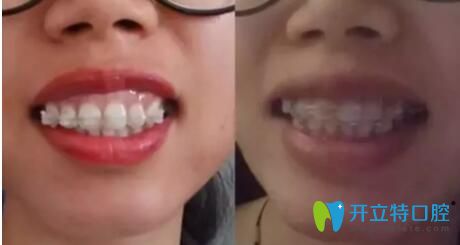 戴牙套改善露齦笑案例