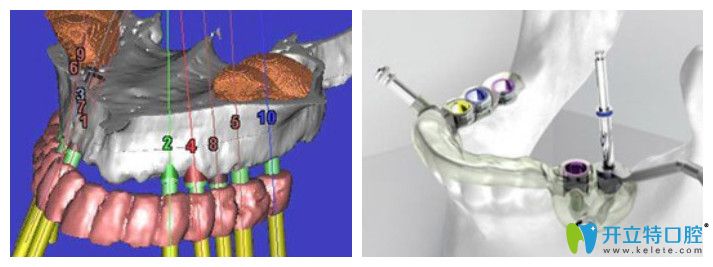 廣大口腔的3d導(dǎo)板精準(zhǔn)種植牙技術(shù)