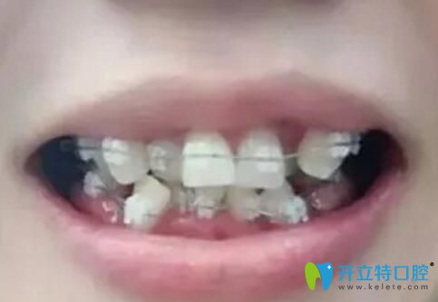 珠海牙齒矯正價(jià)格不妨看看我在九龍口腔花1萬多矯牙后效果