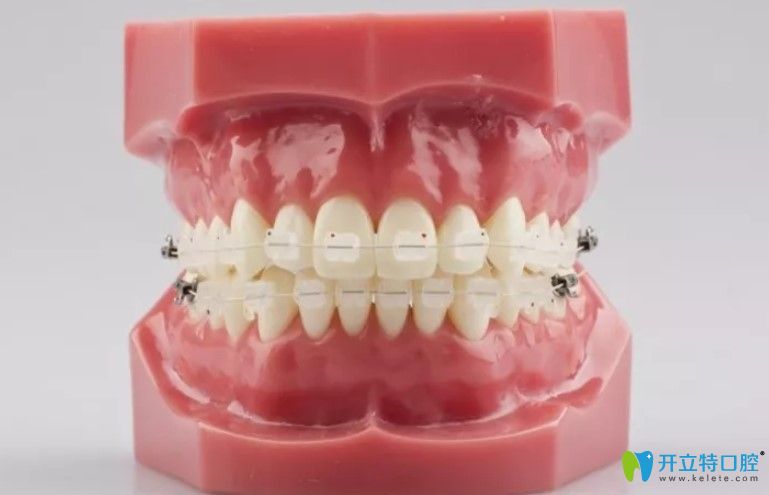 看完半隱形牙齒矯正價格表你就知道陶瓷托槽矯正多少錢啦