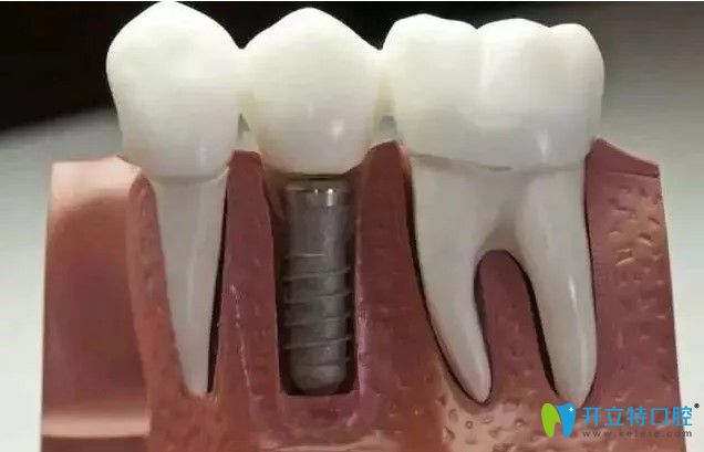 美國百康種植牙脫落了還能不能用