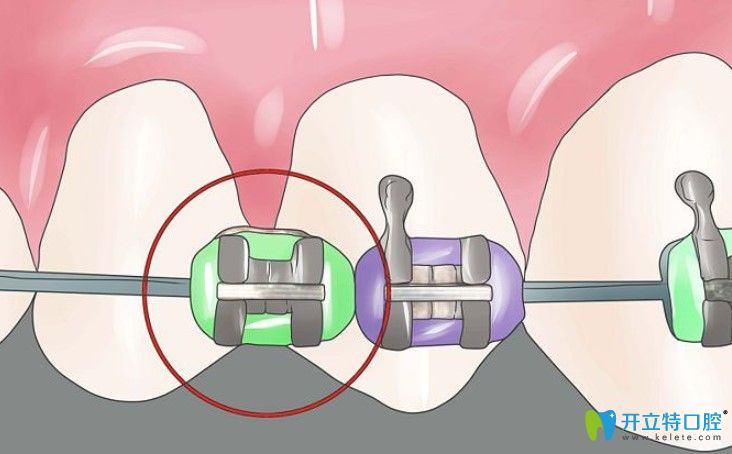 美國(guó)百康種植體脫落了還能用嗎？脫落后多久還可以種牙