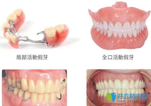 汪醫(yī)生指出大家只要弄清楚這三種修復(fù)方式的優(yōu)缺點之后就知道該如何選擇 汪醫(yī)生指出大家只要弄清楚這三種修復(fù)方式的優(yōu)缺點之后就知道該如何選擇