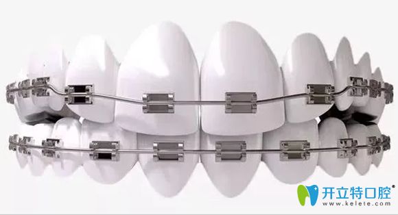 做了4顆烤瓷牙還能做正畸嗎,烤瓷牙在矯正時(shí)會(huì)影響移動(dòng)吧